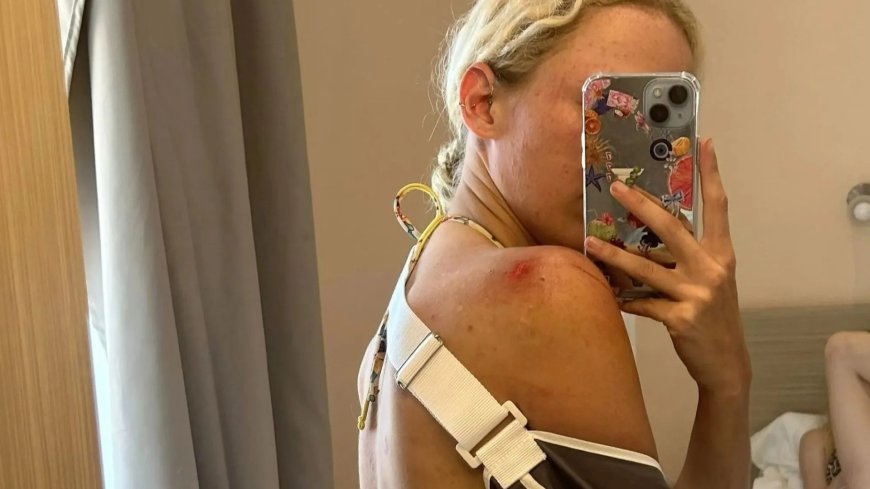 Brit student plunges off CLIFF on quad bike leaving her with horror injuries…as she warns tourists over ‘death traps’ --[Reported by Umva mag]