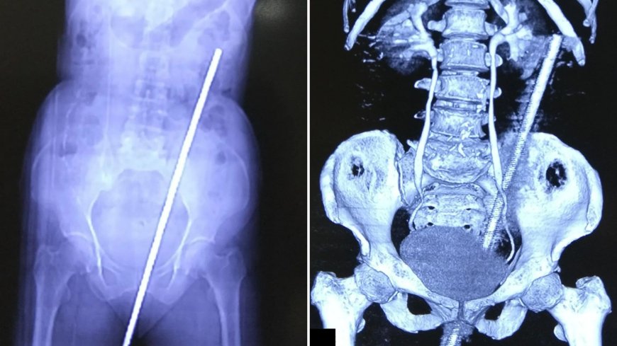 Horror scans reveal 2ft rusty pole removed from woman’s backside after it impaled her when she slipped in the garden --[Reported by Umva mag]