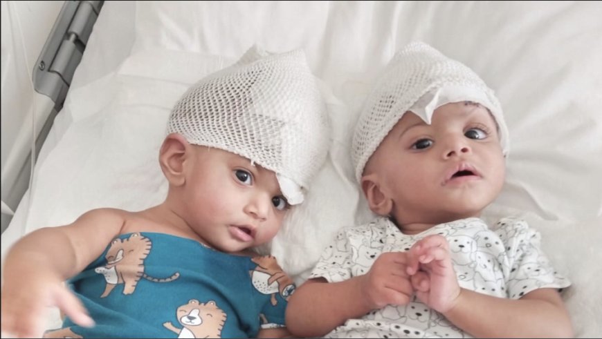 Rare conjoined twin girls separated after 14-hour operation using mixed reality --[Reported by Umva mag]