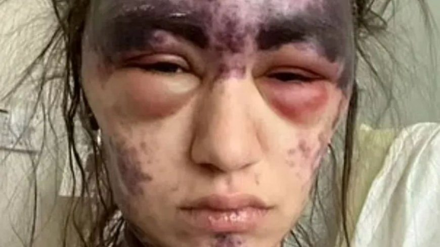 Vaccine horror as woman, 23, left ‘temporarily blind with agonising bruises engulfing her face’ --[Reported by Umva mag]