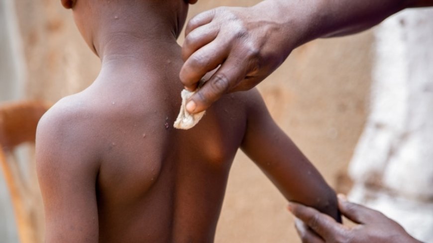 Mpox spreads at alarming rate among children in Burundi --[Reported by Umva mag]