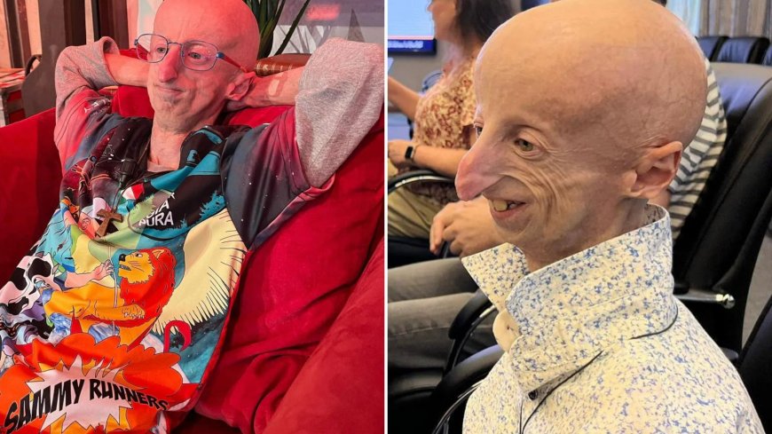 ‘Longest-living Benjamin Button disease sufferer’, 28, who spent his life trying to find a cure for rare condition dies --[Reported by Umva mag]