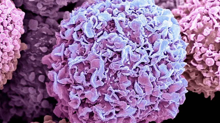 Cancer diagnoses hit an all-time high – as the NHS reveals the most common types of the disease --[Reported by Umva mag]