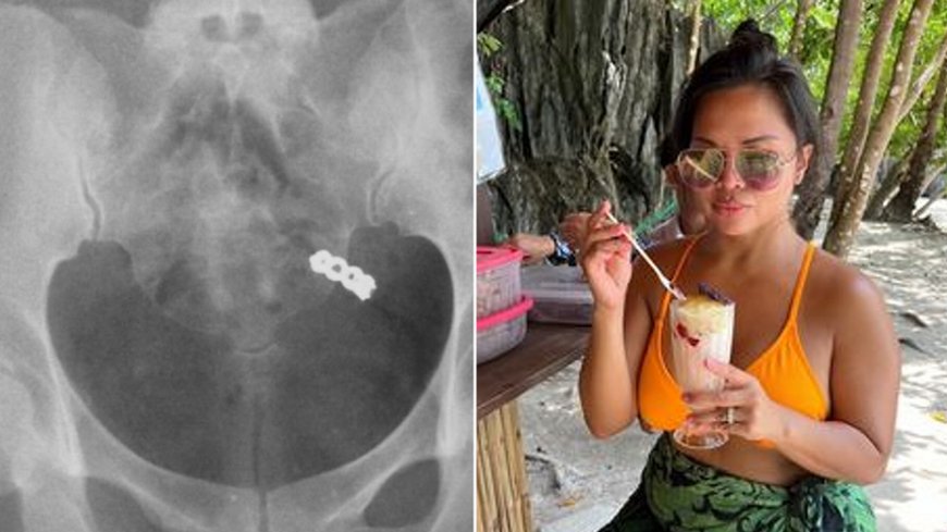 Woman accidentally swallows wedding ring while taking vitamins, X-ray shows --[Reported by Umva mag]