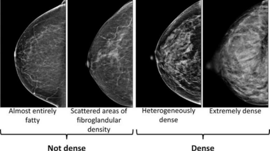 Dense breasts can make it harder to spot cancer on a mammogram --[Reported by Umva mag]